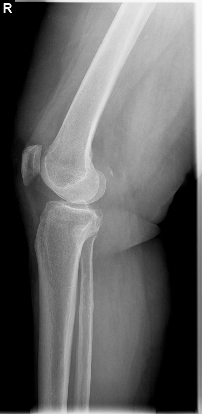 Рентгенорафия коленного сустава. Боковая проекция