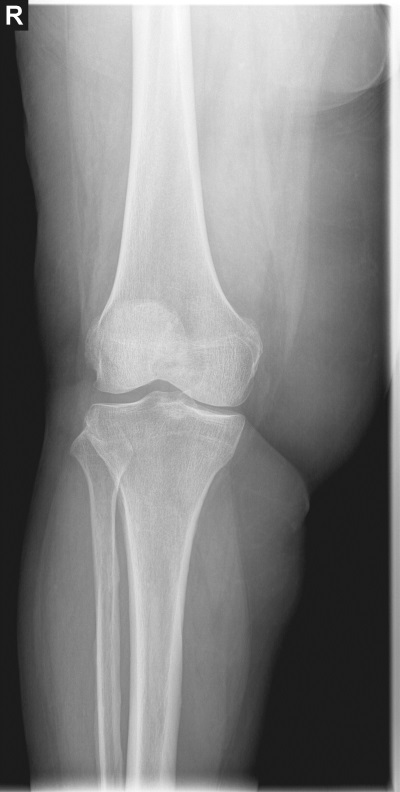 Рентгенорафия коленного сустава. Прямая проекция, стоя