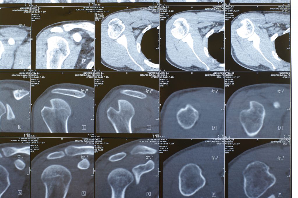 Мрт ключицы и плечевого. Перелом Хилл-Сакса плечевой кости кт. Хилл-Сакса повреждение плеча на кт.