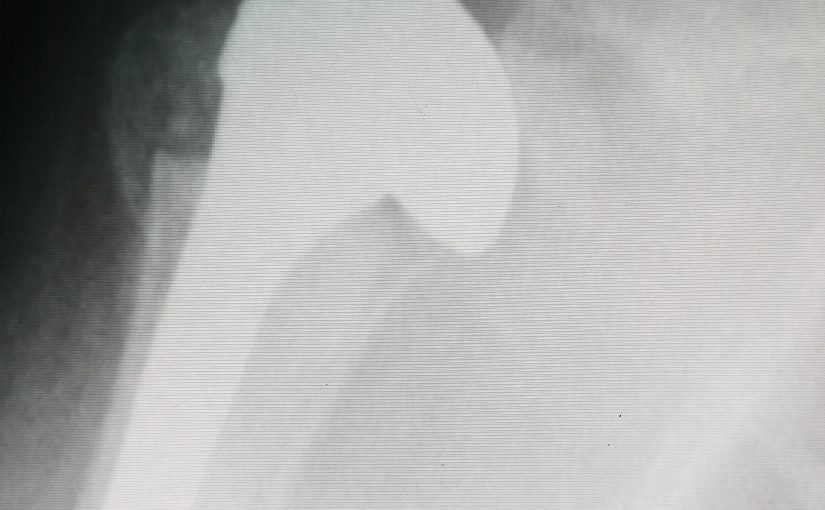 Хирургическое лечение артроза плечевого сустава thumbnail