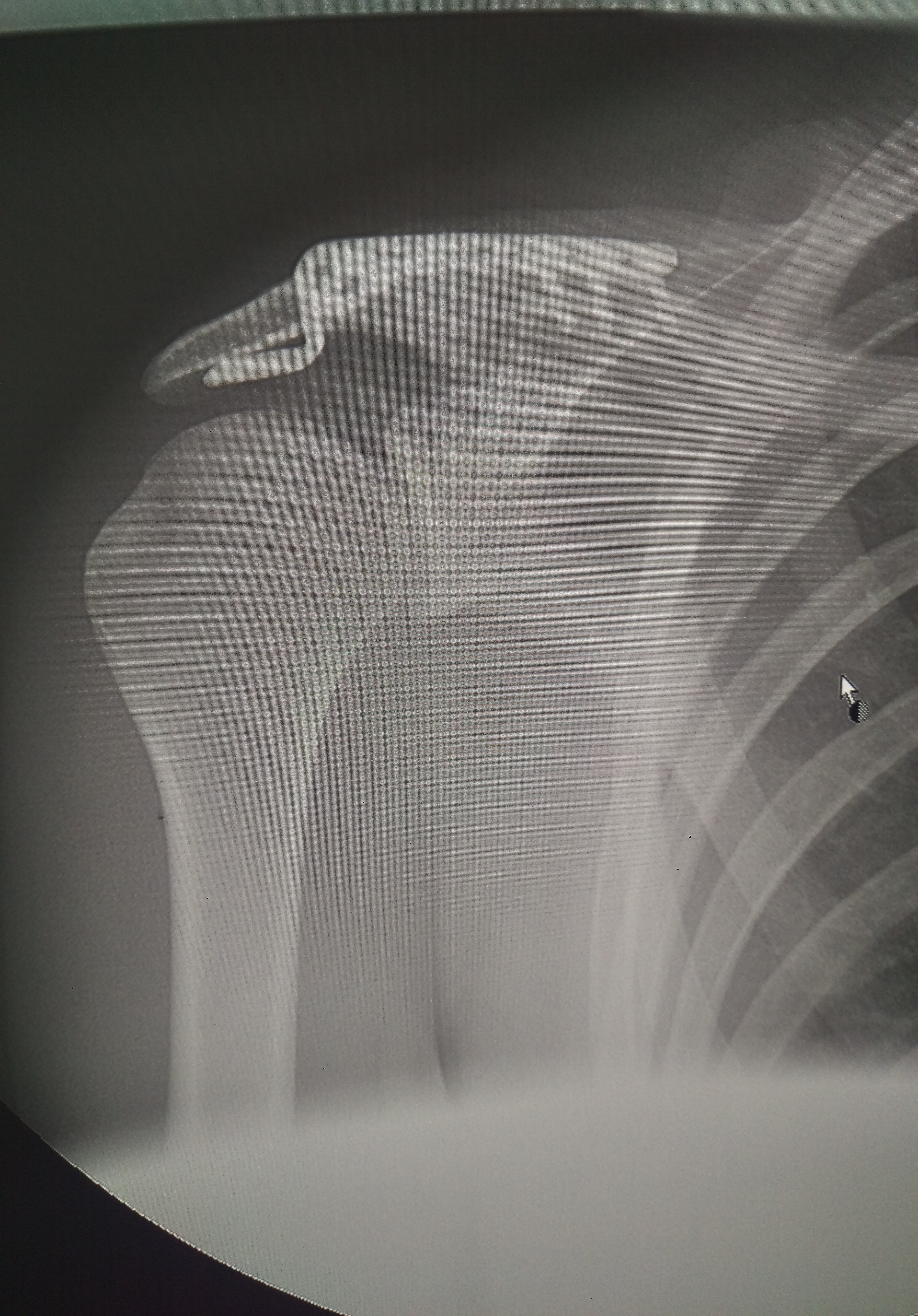 Разрыв сочленений. Акромиально-ключичный сустав (акс). Разрыв акс плечевого сустава рентген. Акромиально-ключичный сустав рентген. Разрыв акромиально-ключичного сочленения рентген.
