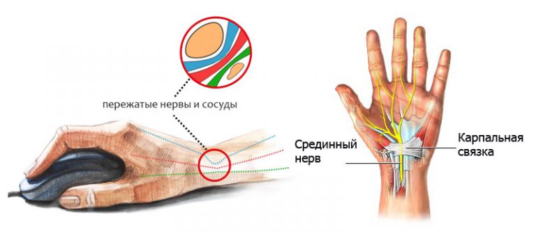 Синдром карпального клапана кисти