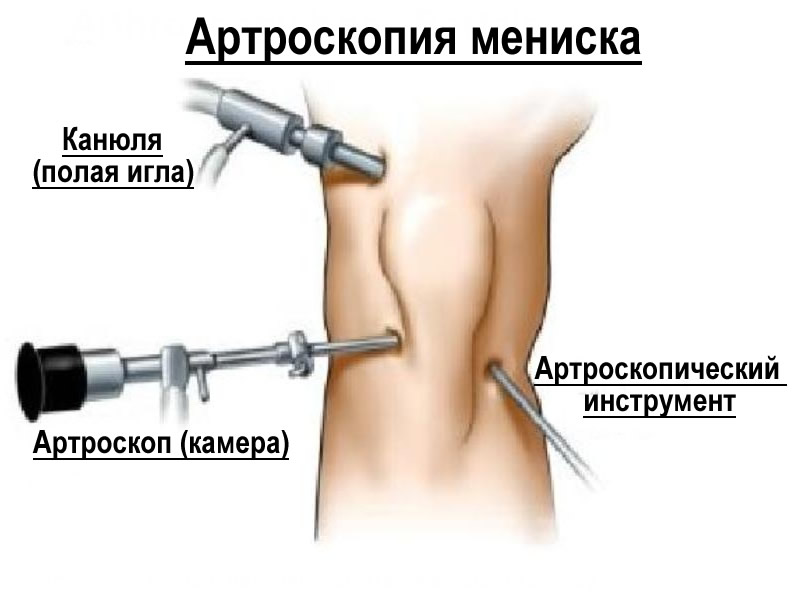 Продольные разрывы менисков коленного сустава Продольные разрывы менисков коленного сустава